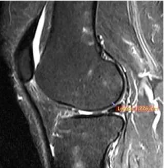 Knee MRI, side view, three years after treatment