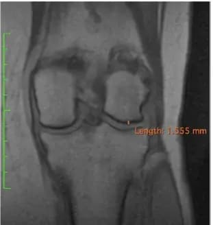 Coronal knee MRI plate at three years