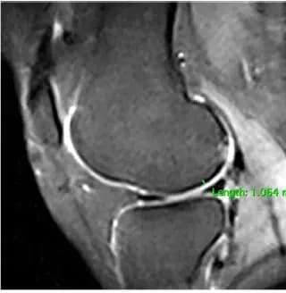 Knee MRI, side view, before treatment
