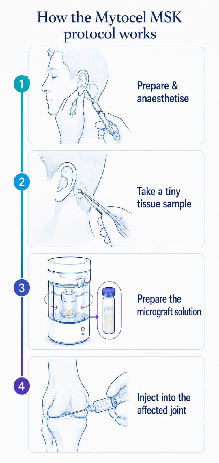 Illustrated plate of the four stages: preparing and anaesthetising the ear, taking a tiny sample, preparing the micrograft solution and injecting it